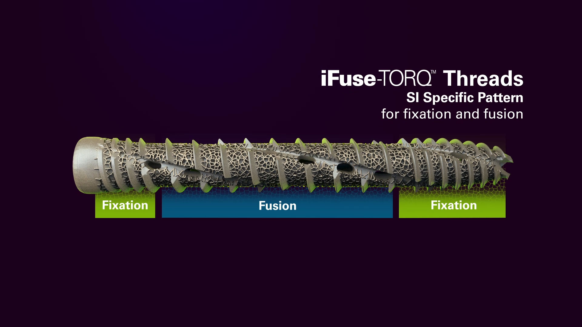 iFuse Torq Implant System